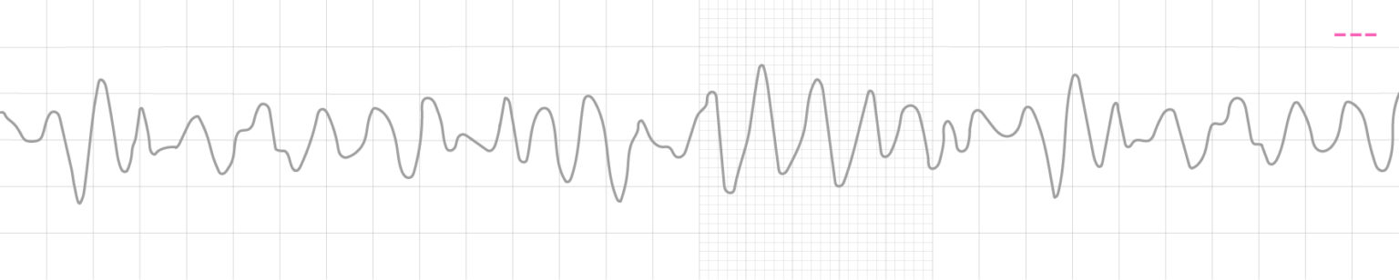 Ventricular Fibrillation | SkillStat