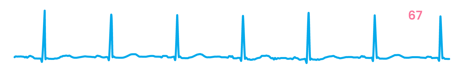 Rhythms Only ECG strip